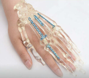 Nur mit neuester, leistungsfähiger Werkzeugtechnologie lassen sich medizinische Komponenten, die oftmals aus schwer zu zerspanenden Materialien bestehen, herstellen bzw. zerspanen.